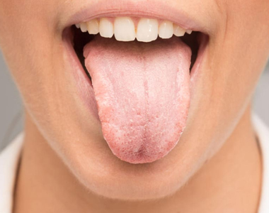 Dry Mouth – Facts and Tips