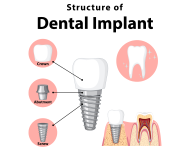 Your Guide to Dental Implants: Restoring Smiles in Mt Pleasant, MI